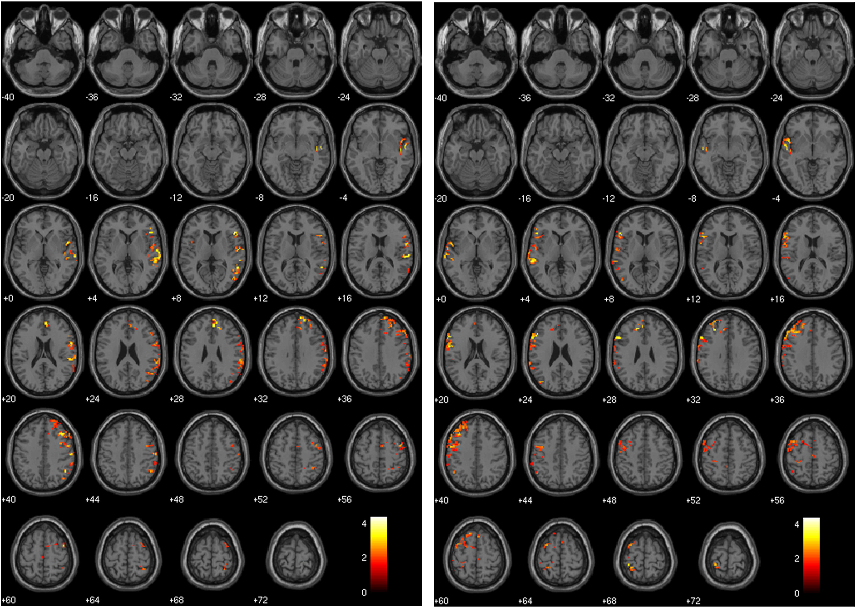 Handedness Prediction from MRI